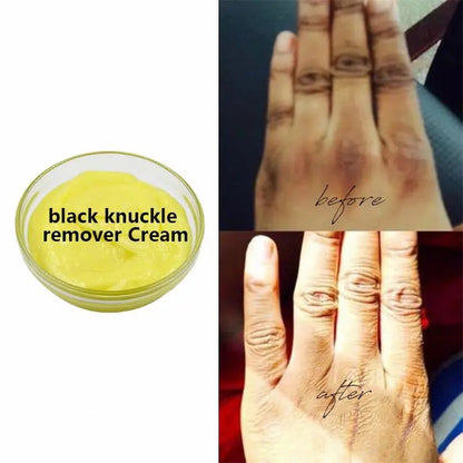 Black Knuckle Removal Cream
