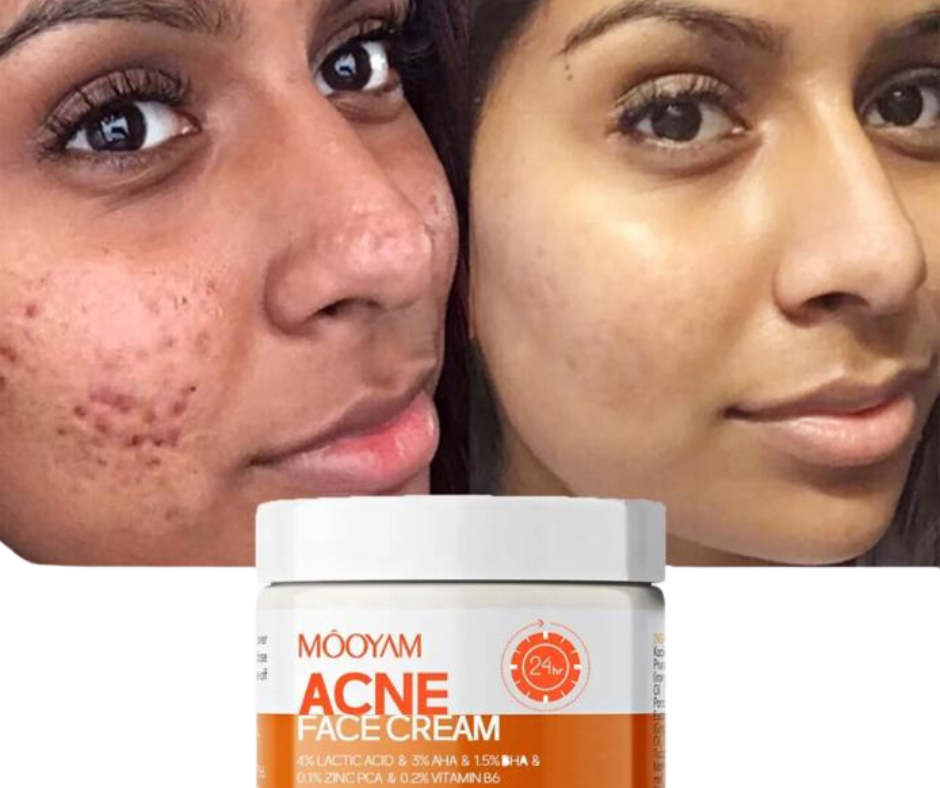 MOOYAM ACNE FACE CREAM