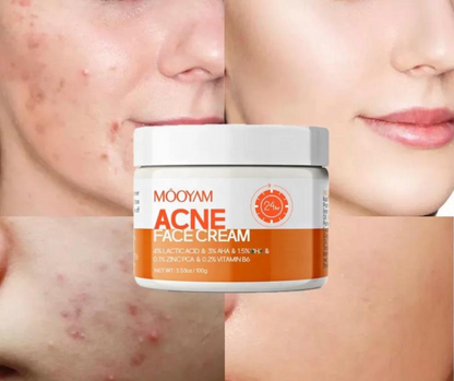 MOOYAM ACNE FACE CREAM