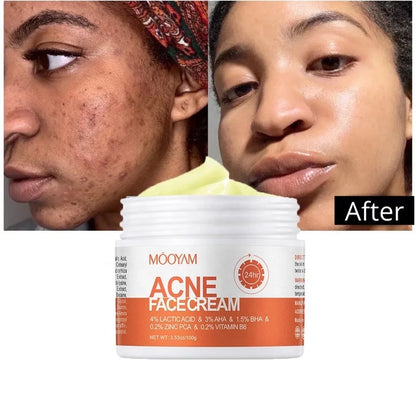 MOOYAM ACNE FACE CREAM